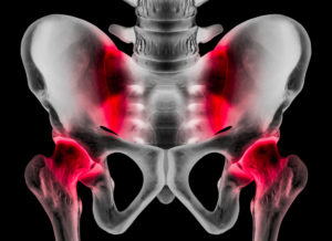 Do I Have Sacroiliac Pain