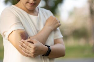 When Should I Be Concerned About a Bruised Arm After a Car Accident?